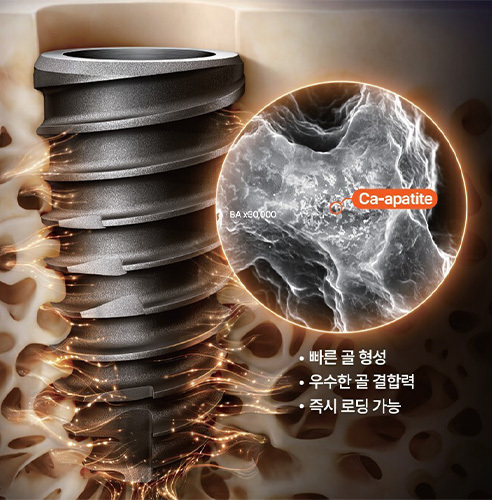 예미담치과 임플란트 재료와 보철물